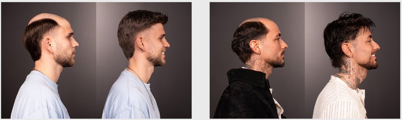 Before-and-after photos from real LaVivid clients