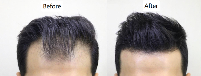Hair Patch Before and After