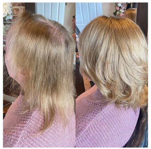 female non-surgical hair replacement